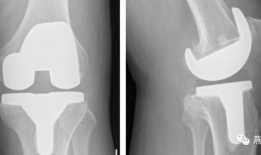 膝关节置换手术视频,从术前准备到术后康复